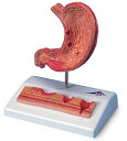 3B社　病理学模型　胃潰瘍モデル　(k17）